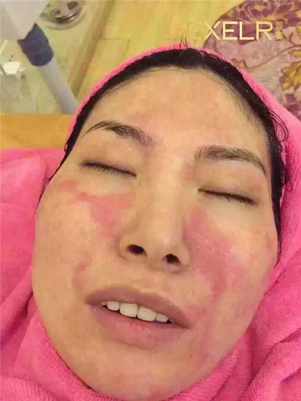 专业护理前:脸部因过敏出现大片红疹 哇,真不敢相信,这是护理完的_脾气网 专业护理前:脸部因过敏出现大片红疹 哇,真不敢相信,这是护理完的